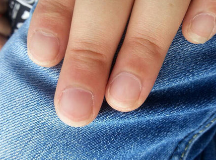 手指甲有竖纹-为什么手指甲有竖纹？